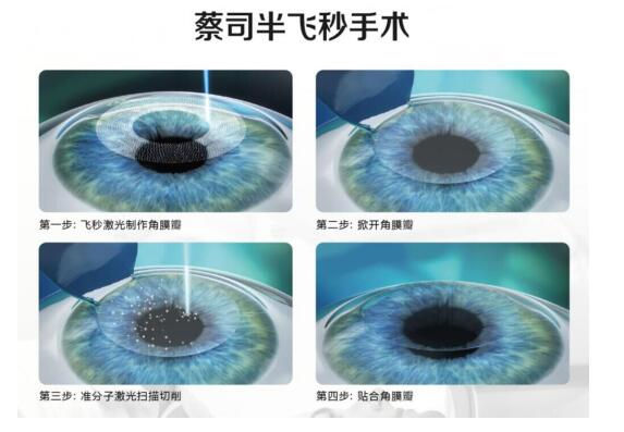 準(zhǔn)分子激光手術(shù)到底是怎么治 愈你的眼睛的？
