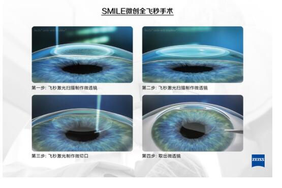 準(zhǔn)分子激光手術(shù)到底是怎么治 愈你的眼睛的？