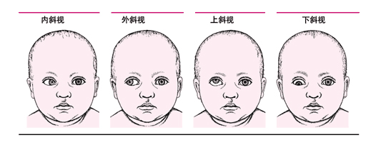 孩子有斜視做手術(shù)矯正有什么危險？