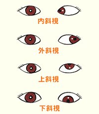 看看兒童斜視眼病怎么預(yù)防？