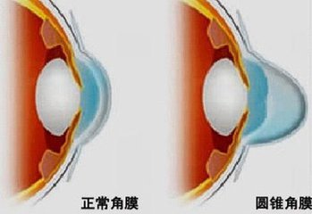 圓錐角膜，哪種角膜移植術(shù)好？