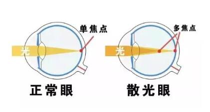 近視和散光，手術(shù)能同時矯正嗎？