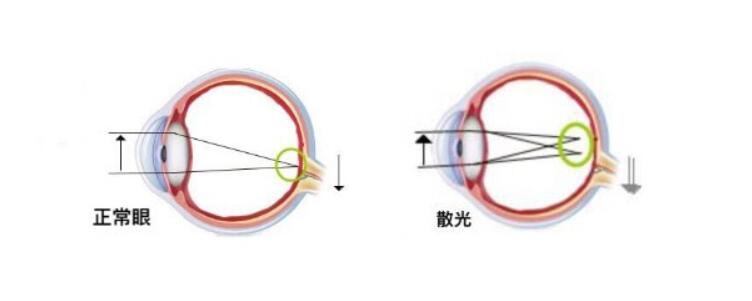 高度散光加近視可以做手術(shù)嗎？